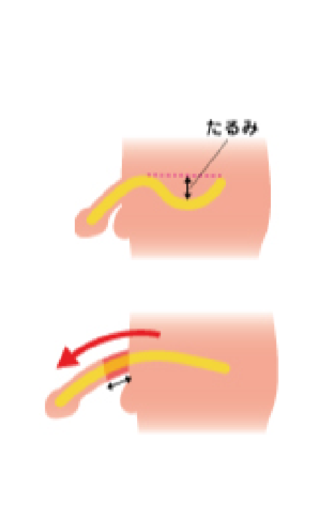 長茎術の手術方法の画像