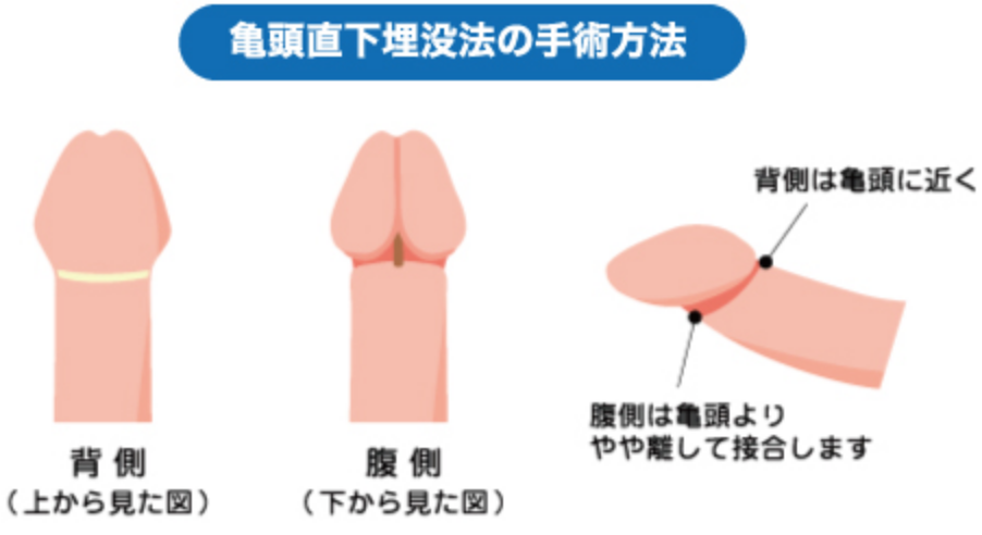 亀頭直下埋没法の手術方法の画像