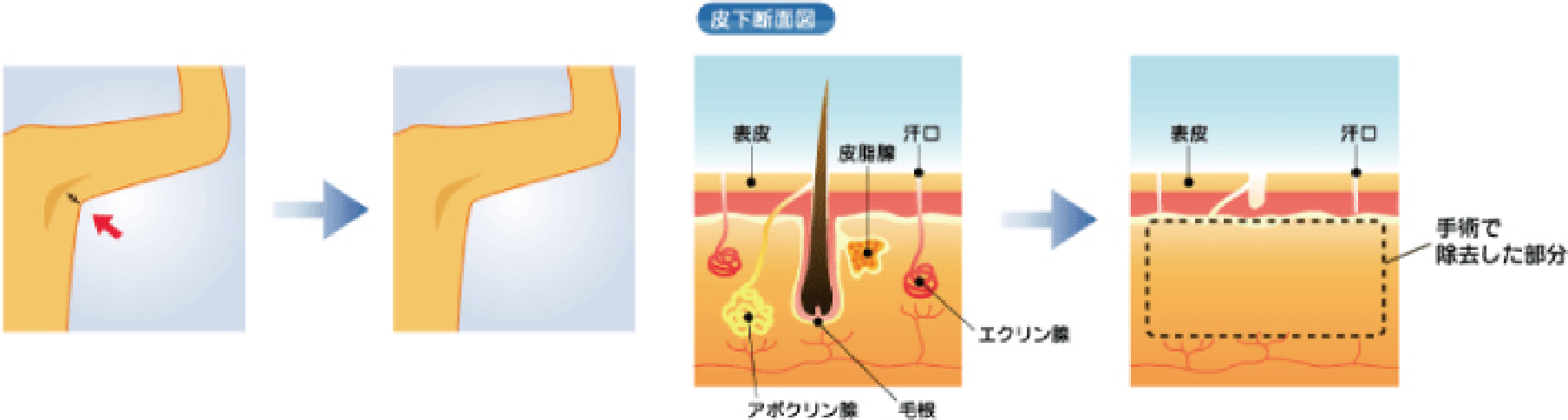 ワキガ治療の説明画像